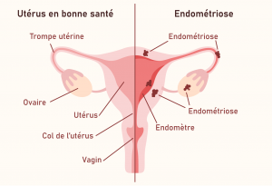l’endométriose, L’endométriose